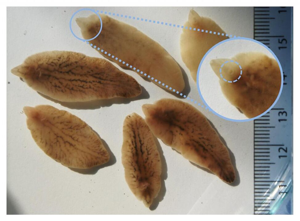 liver flukes