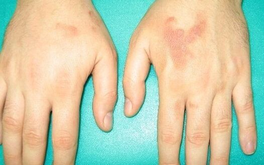 Pain in the joints of the hands can be a symptom of parasites.