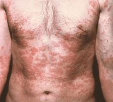 Problematic skin is a symptom of the presence of parasites.