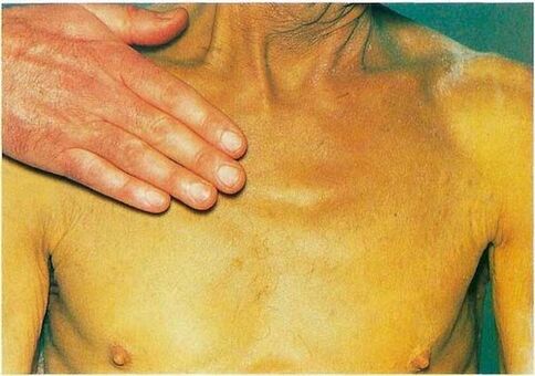 Jaundice due to parasites in the body.