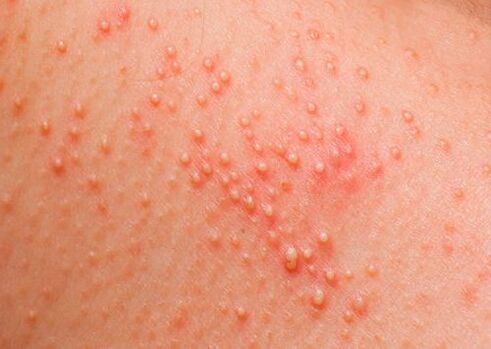 If the body is affected by parasites, a skin allergy appears. 
