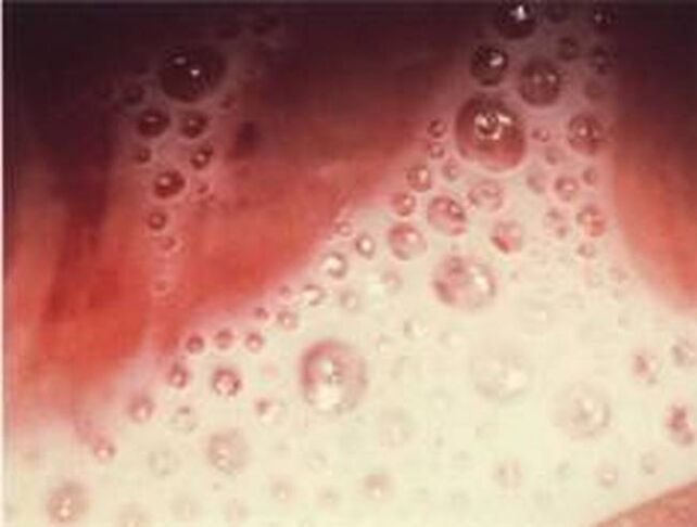bubble secretion with protozoan parasites