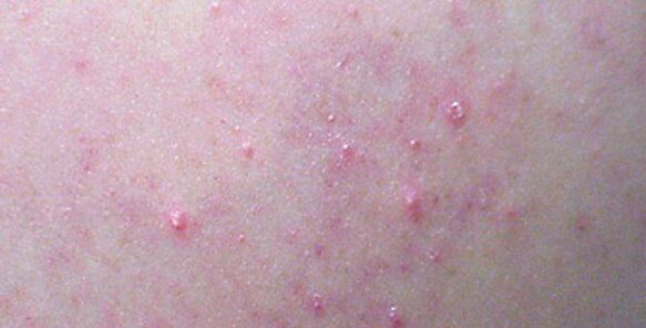 Rashes on the body can be a sign of helminthiasis. 